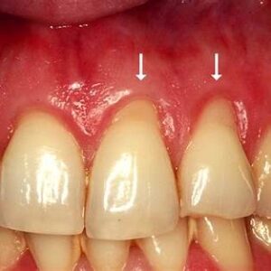 Blottlagda tandhalsar med gingival retraktion markerat med pilar – vanlig orsak till ilningar i tänderna.